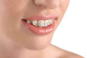 closeup of smile with clear bracket and wire braces