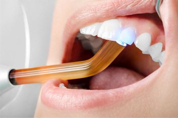 Curing light in patient’s mouth, behind front teeth