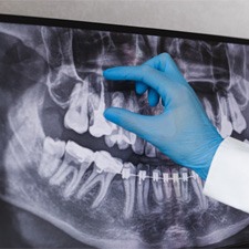 Waco emergency dentist examining X-ray