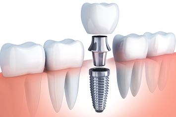 dental implant being placed in the lower jaw