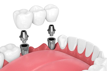 two dental implant posts supporting a dental bridge