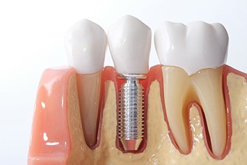 dental implant in a model of the jaw