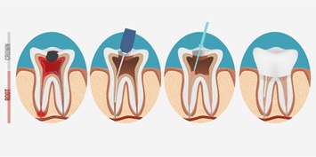 illustration of root canal therapy 
