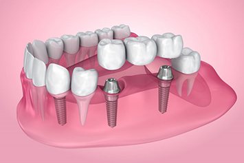Exploded illustration of dental implants in gum tissue with bridge