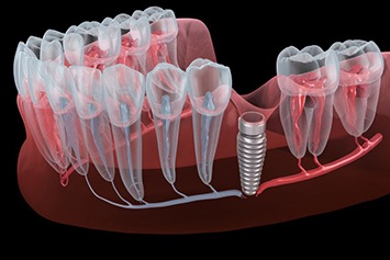 Illustration of dental implant in jaw tissue