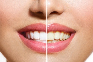 A smile before and after teeth whitening