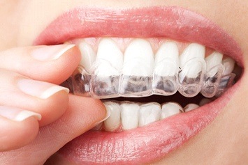 Woman putting in a whitening tray 