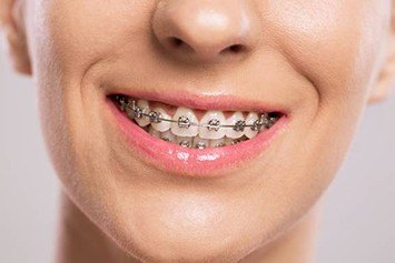 Close up smile with braces
