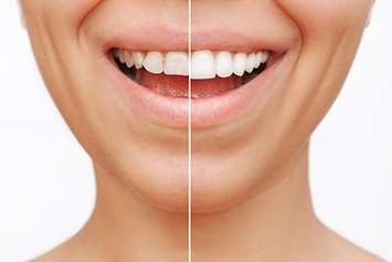 A before-and-after photo of a woman with veneers