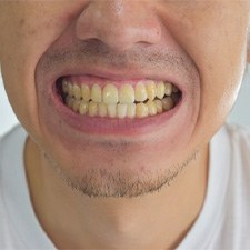 A closeup of a man with a dirty, stained smile