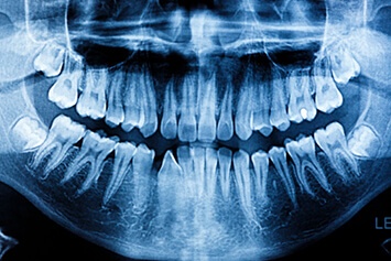 xray of a full mouth