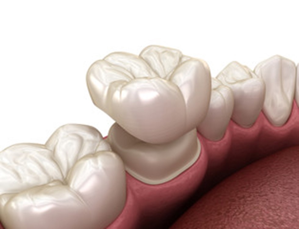 Image of dental crown being placed on a tooth.